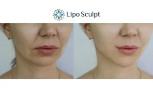 Explaining Total Skin Tightening Treatment And What It Can Do For You 2 Do you want to boost your self confidence? Give Morpheus8 Huddersfield a try today!