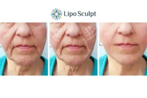 Explaining Total Skin Tightening Treatment And What It Can Do For You 3 Boost your confidence with Morpheus8 Huddersfield call our team today!