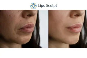 Explaining Total Skin Tightening Treatment And What It Can Do For You 4 Morpheus8 Huddersfield the best results - call our team today!