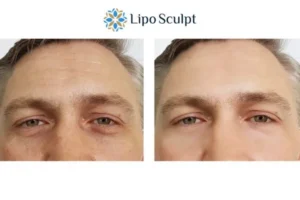 Explaining Total Skin Tightening Treatment And What It Can Do For You 6 Morpheus8 Huddersfield book in today to find out more!