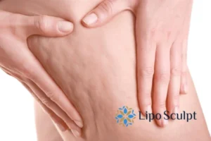 Start your journey today book your coolsculpting treatment Huddersfield online today!