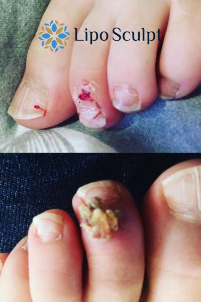 Wart removal customer results from Lipo Sculpt Huddersfield