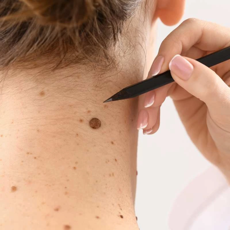How to Support Your Body During Pregnancy for Faster Postnatal Recovery 5 See our lesion removal prices Huddersfield - call today for a free quote